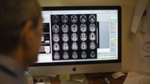 Áttörés az Alzheimer-kutatásban, új korszak kezdődhet a gyógyításban