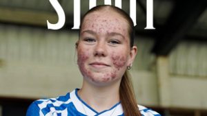Bőrbetegsége miatt gyűlöletcunami zúdult a 16 éves focista lányra, minden profilját letiltotta