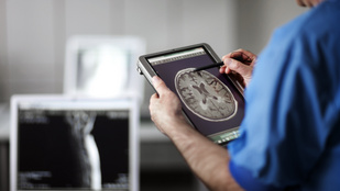 Áttörés jön az Alzheimer-kór kutatásában, egy népszerű fogyókúrás szer segíthet